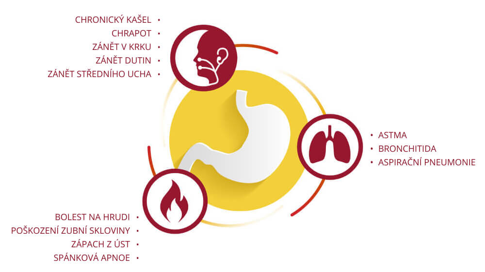 GERD může rovněž ovlivňovat orgány, které s jícnem přímo nesouvisí, tedy nos, uši, krk a plíce.