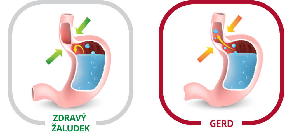 Gastroezofageální refluxní choroba